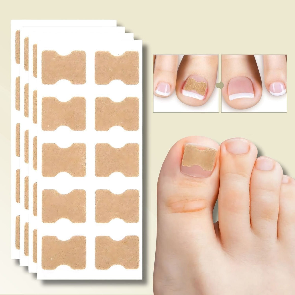Ingrown Nail Treatment Corrector Patches with Adhesive Peel and Stick Application