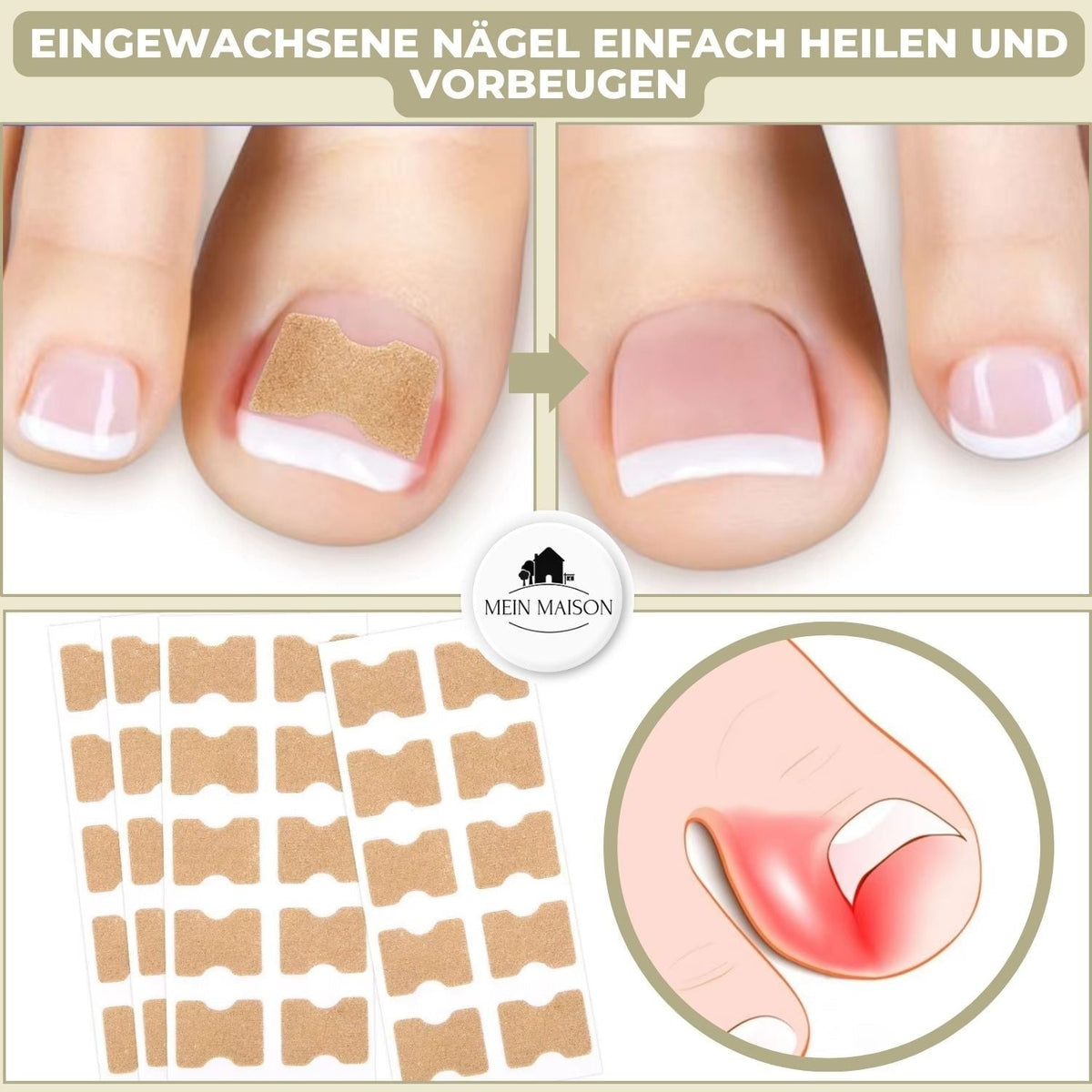 Ingrown Nail Treatment Corrector Patches with Adhesive Peel and Stick Application