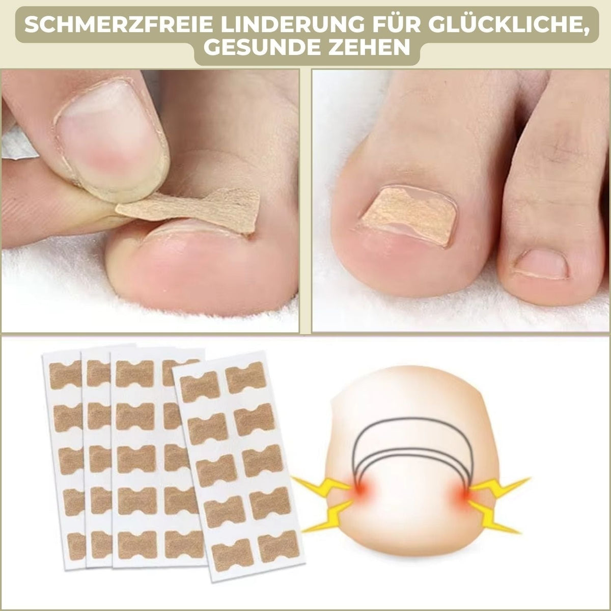 Ingrown Nail Treatment Corrector Patches with Adhesive Peel and Stick Application