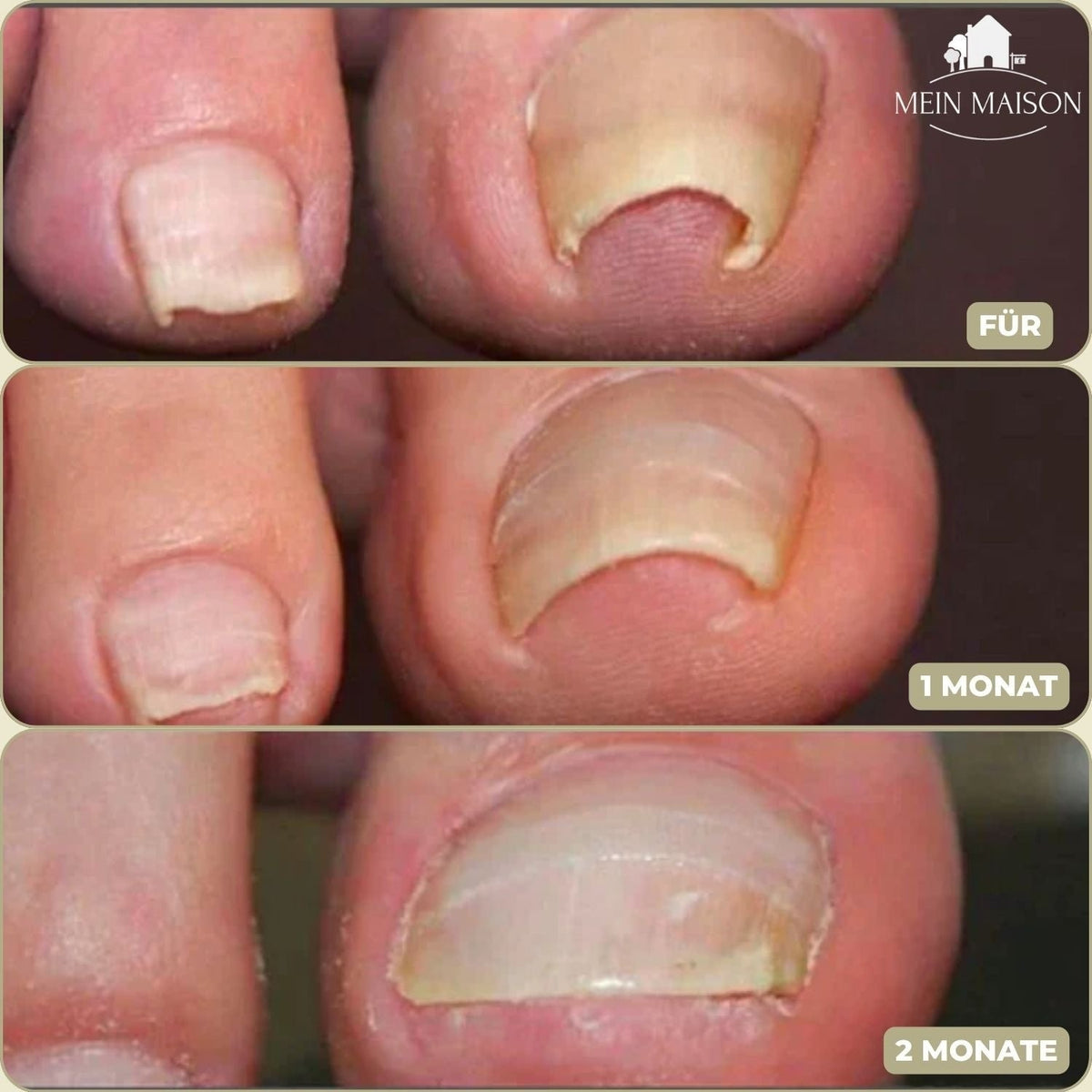 Ingrown Nail Treatment Corrector Patches with Adhesive Peel and Stick Application