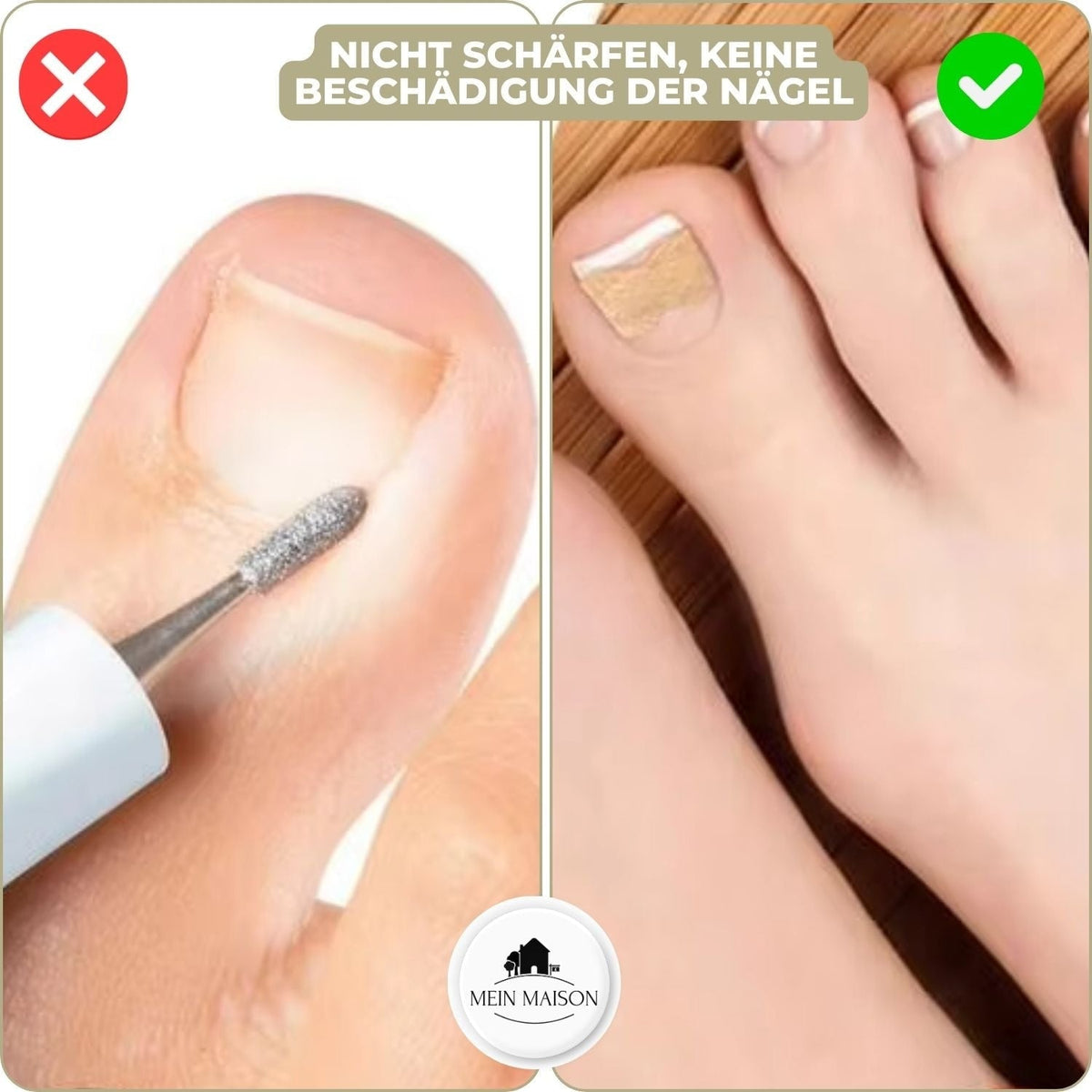 Ingrown Nail Treatment Corrector Patches with Adhesive Peel and Stick Application
