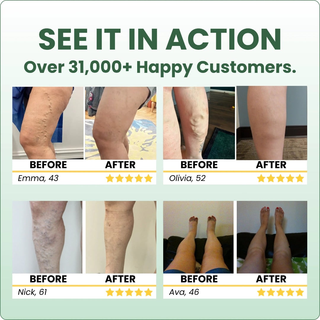 Varicose Vein with Horse Chestnut Arnica Calendula Balm
