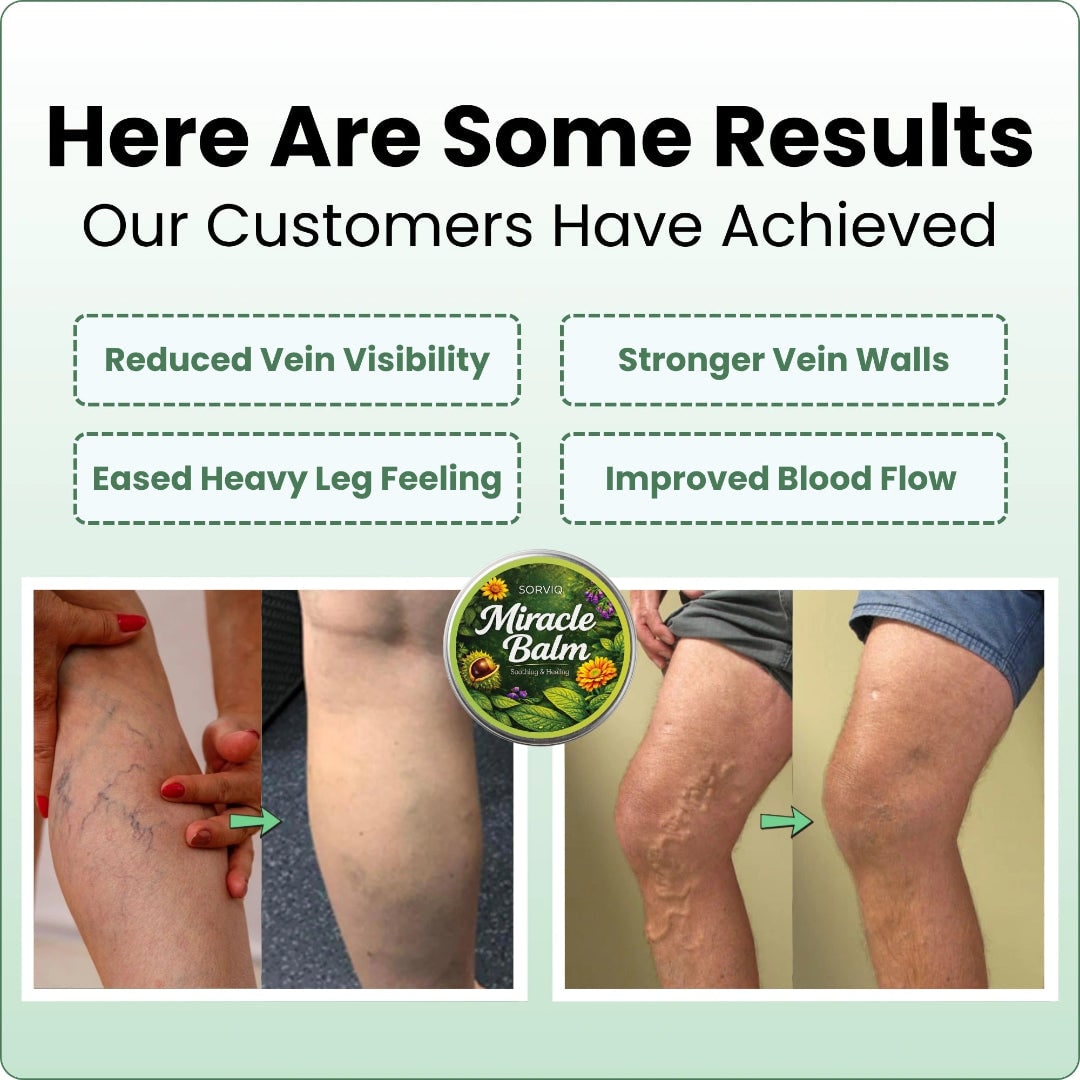Varicose Vein with Horse Chestnut Arnica Calendula Balm